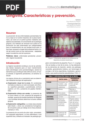 Gingivitis. Características y prevención (Artículo)